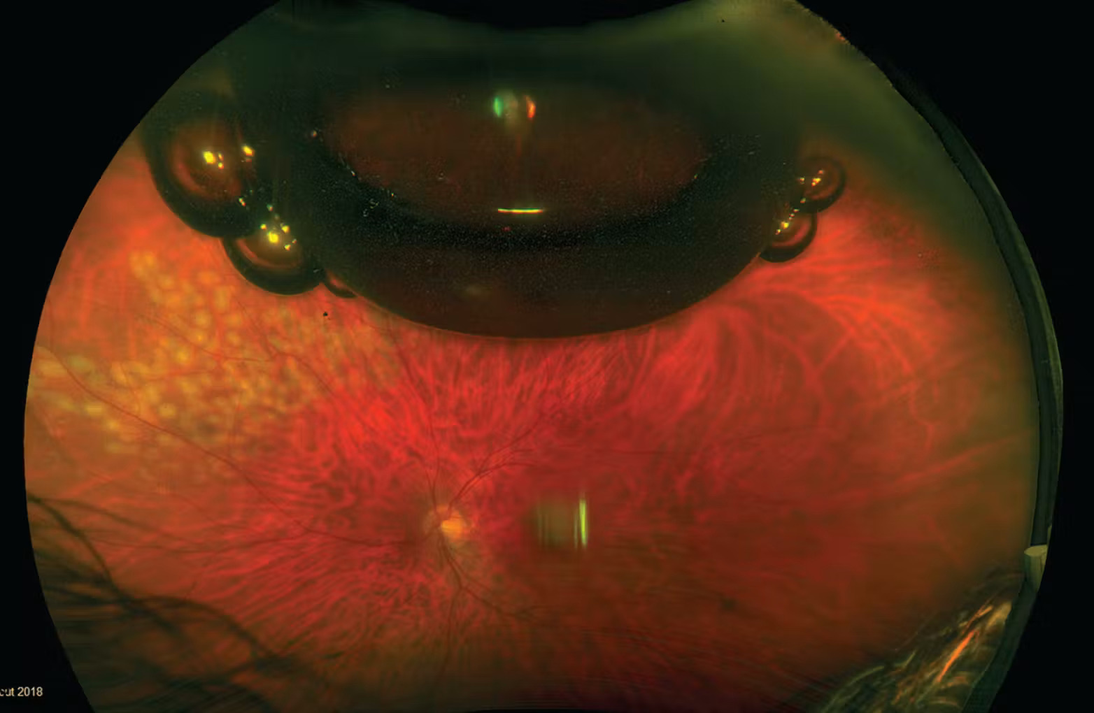 Vitreous substitutes: wide-field fundus view showing an intraocular gas bubble meniscus after vitrectomy