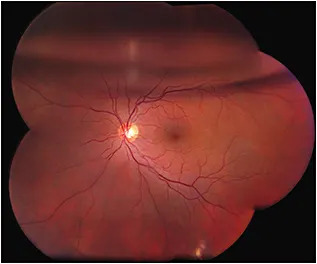 Vitreous substitutes: postoperative fundus photograph following gas tamponade