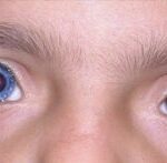 Waardenburg syndrome: complete heterochromia iridis with one bright blue eye and one brown eye