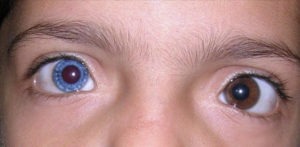 Waardenburg Syndrome: When Iris Color Points to Hearing Loss