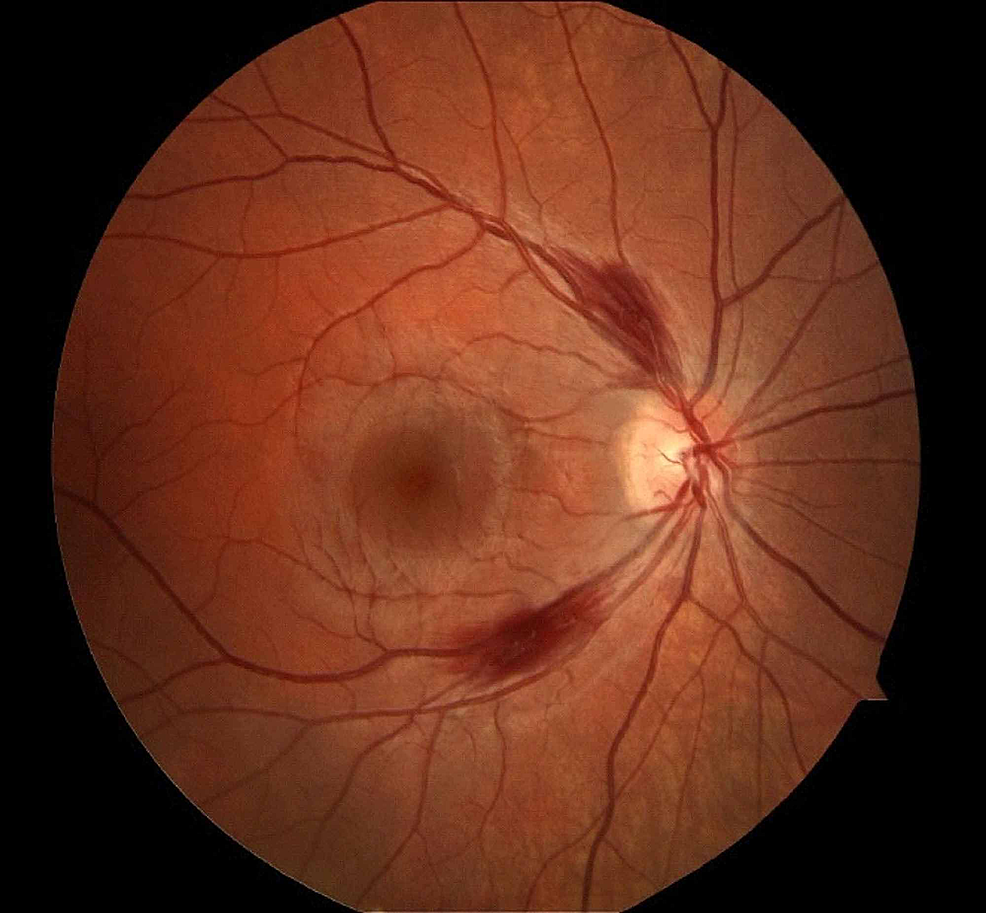 Wernicke encephalopathy: peripapillary hemorrhage adjacent to the optic disc