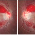 Wernicke encephalopathy: peripapillary retinal hemorrhage, an associated fundus finding reported alongside the classic ocular motility signs