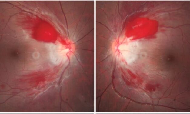 Wernicke Encephalopathy: The Eye Findings That Signal an Emergency