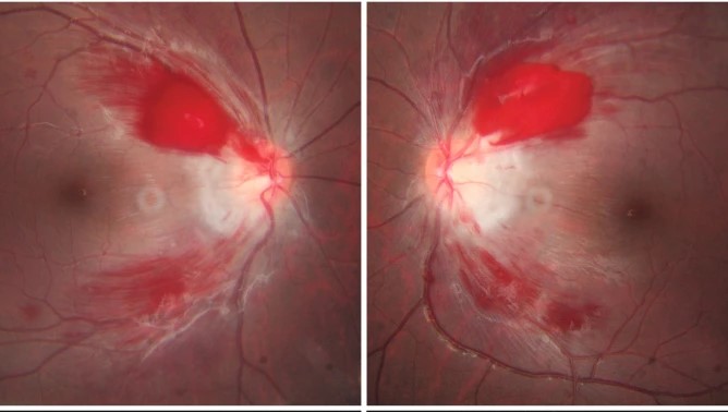 Wernicke Encephalopathy: The Eye Findings That Signal an Emergency