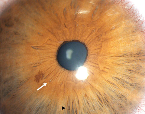 Williams Syndrome: The Stellate Iris Pattern