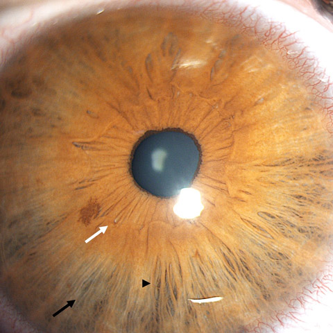 Williams Syndrome Stellate Iris Pattern Williams syndrome: stellate lacy iris pattern