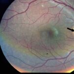 Wolfram syndrome: fundus photograph showing optic disc pallor from optic atrophy without diabetic retinopathy