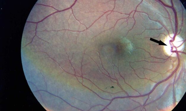 Wolfram Syndrome: When Optic Atrophy Follows Childhood Diabetes