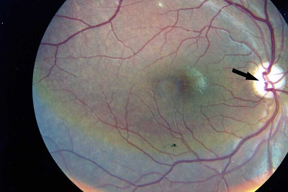 Wolfram Syndrome: When Optic Atrophy Follows Childhood Diabetes