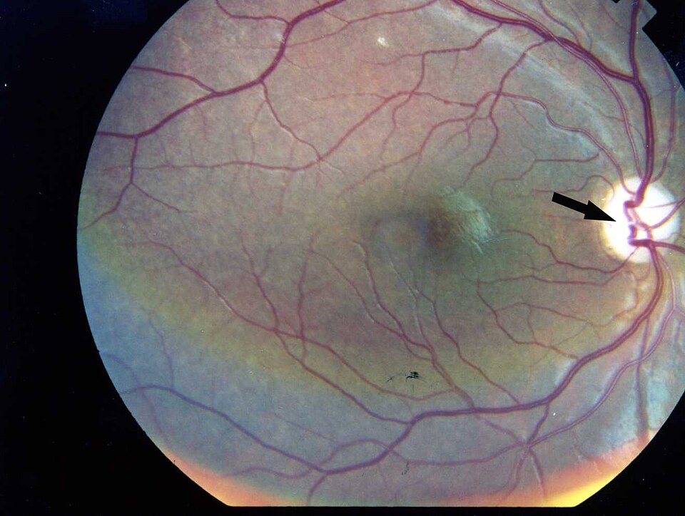 Wolfram syndrome: fundus photograph showing optic disc pallor from optic atrophy without diabetic retinopathy