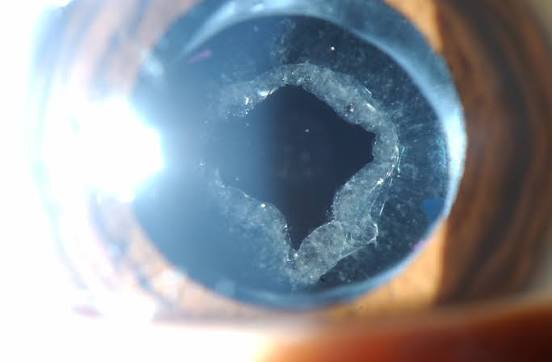 YAG Laser Capsulotomy: Fixing the Secondary Cataract Without a Knife