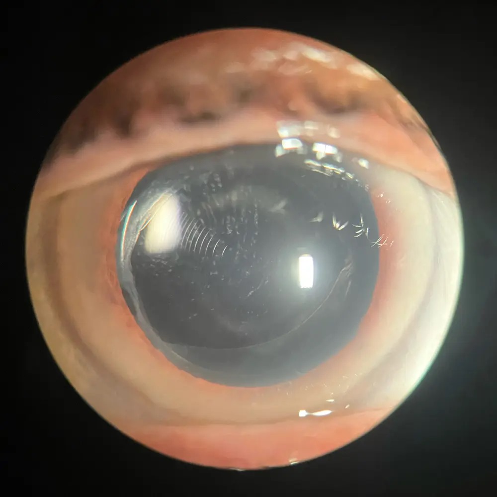 YAG laser capsulotomy: slit-lamp view of the eye during posterior capsule treatment