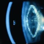 Zonular (lamellar) cataract: slit-lamp optical section showing a discrete lamellar opacity within the lens