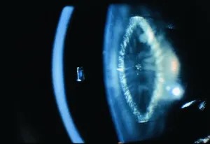 Zonular (Lamellar) Cataract: The Most Common Congenital Pattern