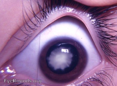 Zonular (lamellar) cataract: central lens opacity with the characteristic 'riders' pattern