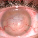Clinical eye photograph illustrating Acanthamoeba Ring Infiltrate