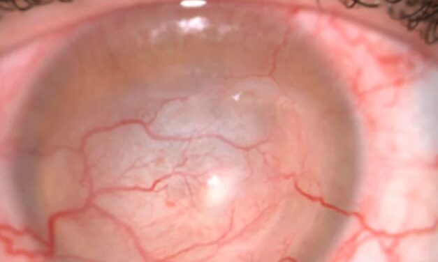 Acanthamoeba Ring Infiltrate: A Late, Ominous Sign in a Notoriously Missed Infection