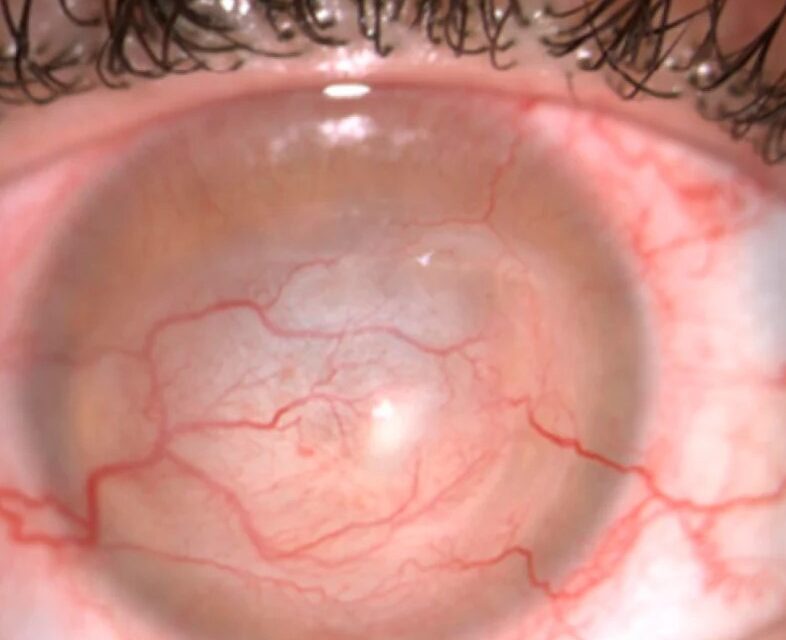 Acanthamoeba Ring Infiltrate: A Late, Ominous Sign in a Notoriously Missed Infection