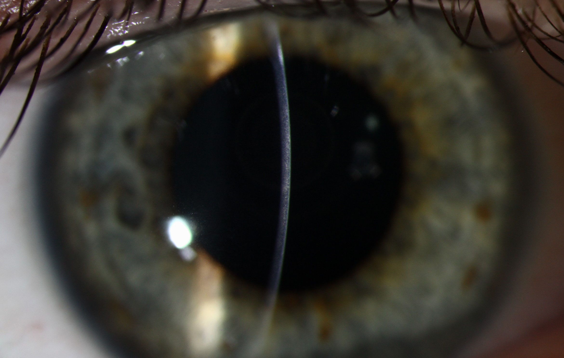 Clinical eye photograph illustrating Acanthamoeba Ring Infiltrate