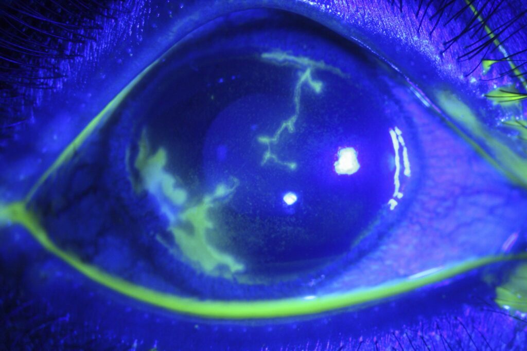 Clinical image illustrating Acyclovir Prophylaxis for Herpetic Eye Disease (figure 1)