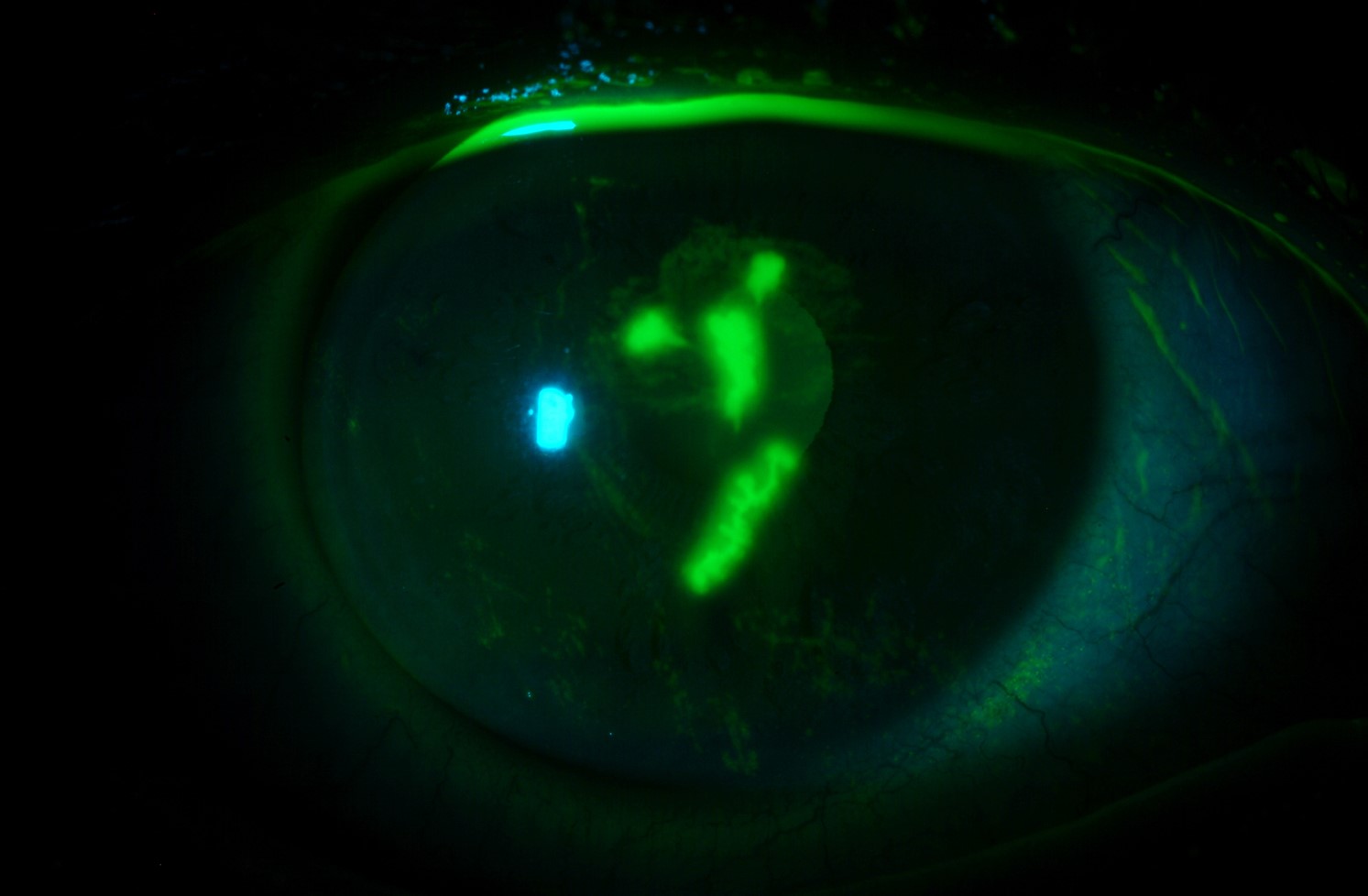 Clinical image illustrating Acyclovir Prophylaxis for Herpetic Eye Disease (figure 2)