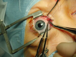 Clinical image illustrating Adult Strabismus