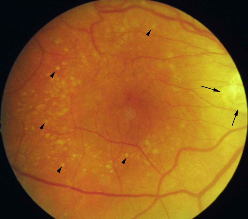 Clinical eye photograph illustrating Age Related Macular Degeneration Risk Factors