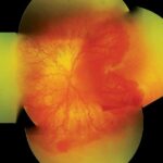Clinical eye photograph illustrating Aggressive Posterior Rop