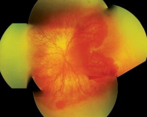 Clinical eye photograph illustrating Aggressive Posterior Rop