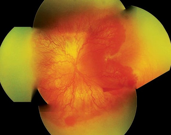 Clinical eye photograph illustrating Aggressive Posterior Rop