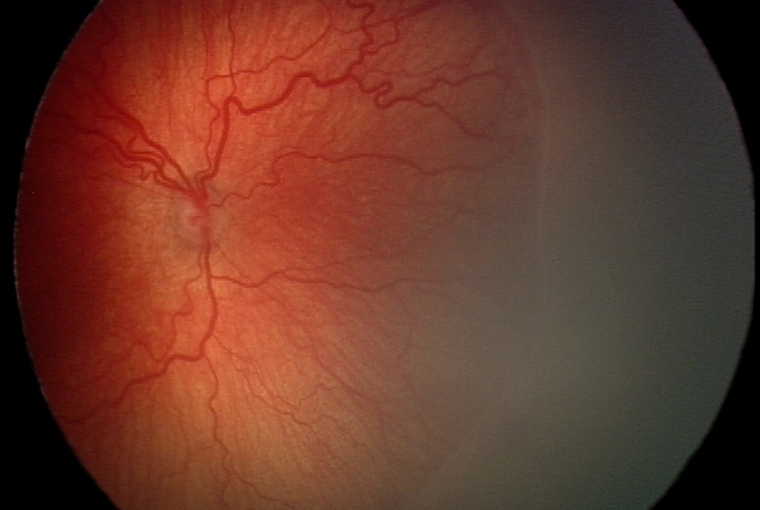 Clinical eye photograph illustrating Aggressive Posterior Rop