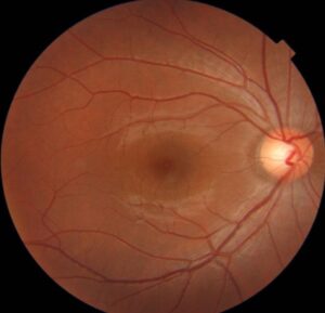 Clinical eye photograph illustrating Alzheimer Disease Retina Biomarkers Oct