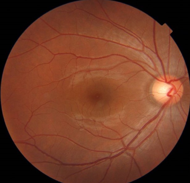 Clinical eye photograph illustrating Alzheimer Disease Retina Biomarkers Oct