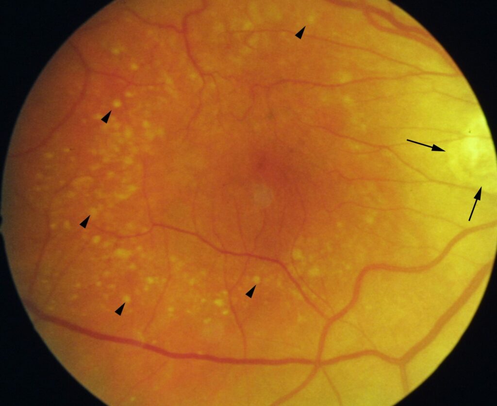 Clinical eye photograph illustrating Amd Genetics Cfh Arms2 Risk Score