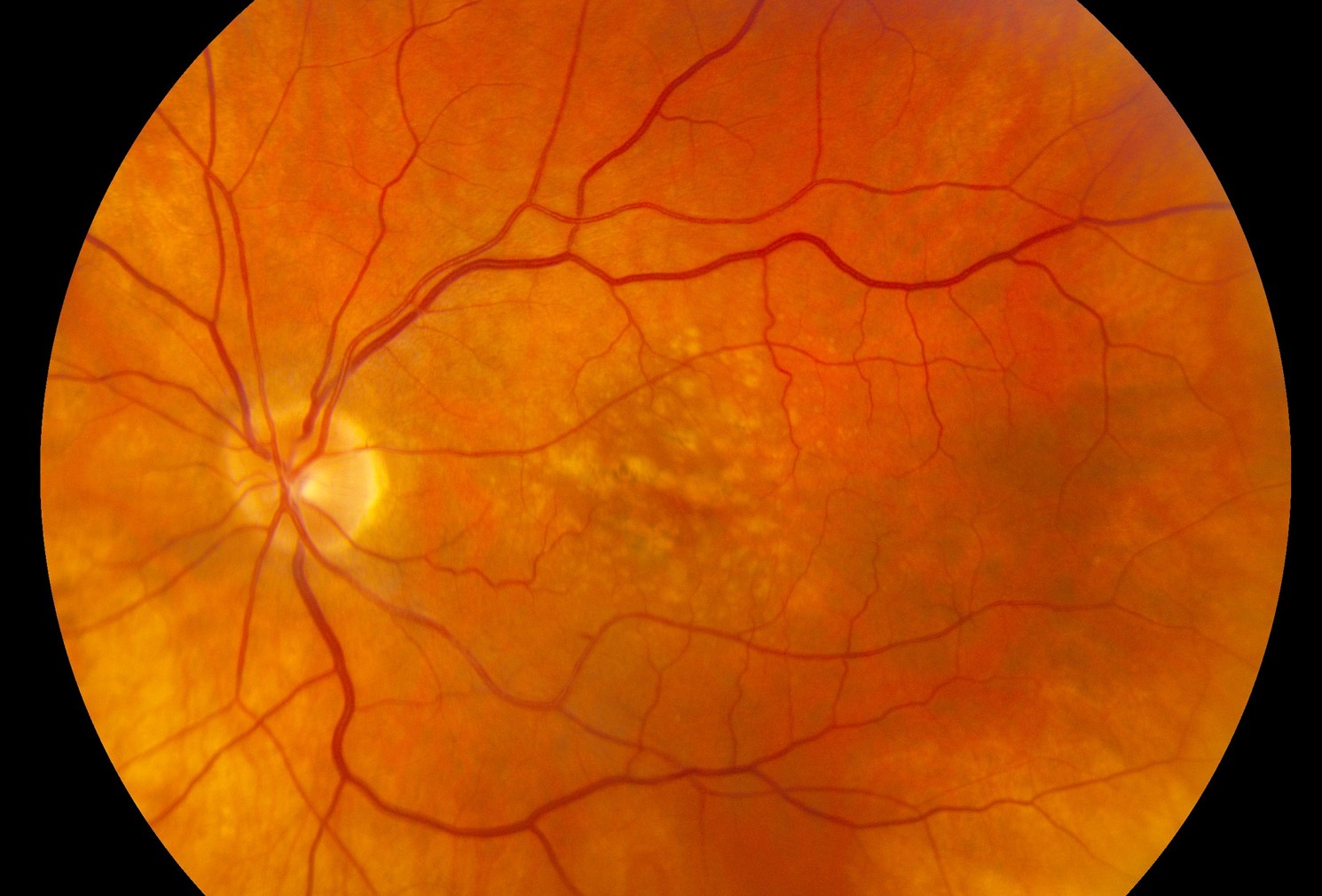 Clinical eye photograph illustrating Amd Genetics Cfh Arms2 Risk Score