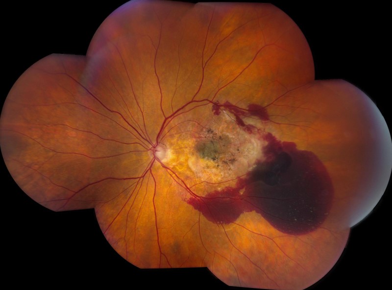 Low Vision Rehabilitation in AMD: What Helps