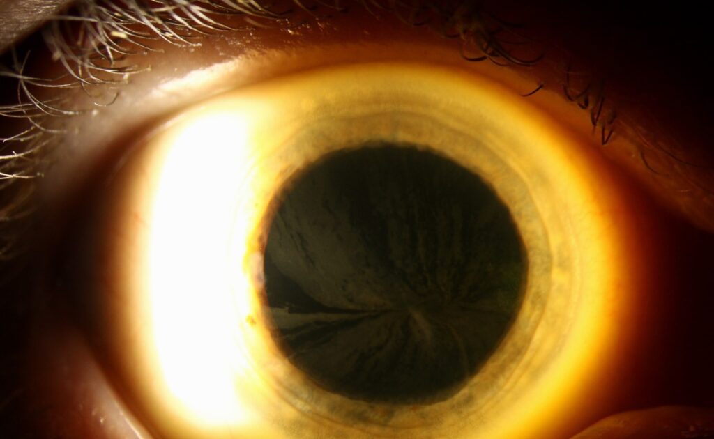 Clinical eye photograph illustrating Amiodarone Optic Neuropathy