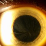 Clinical eye photograph illustrating Amiodarone Optic Neuropathy