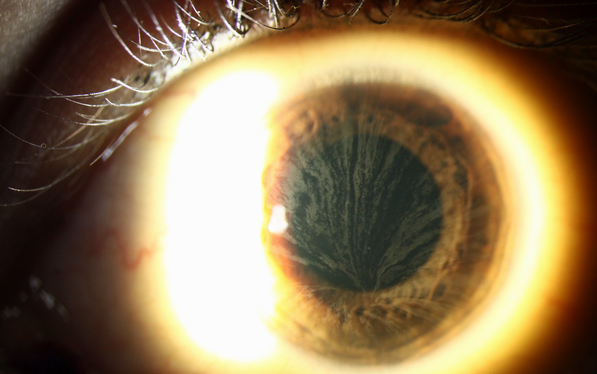 Clinical eye photograph illustrating Amiodarone Optic Neuropathy