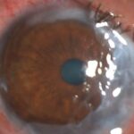 Clinical eye photograph illustrating Amniotic Membrane Transplant Indications