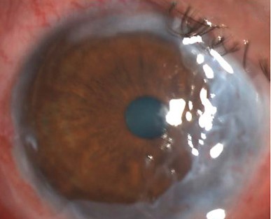 Amniotic Membrane Transplantation: One Tissue, Several Different Jobs on the Ocular Surface