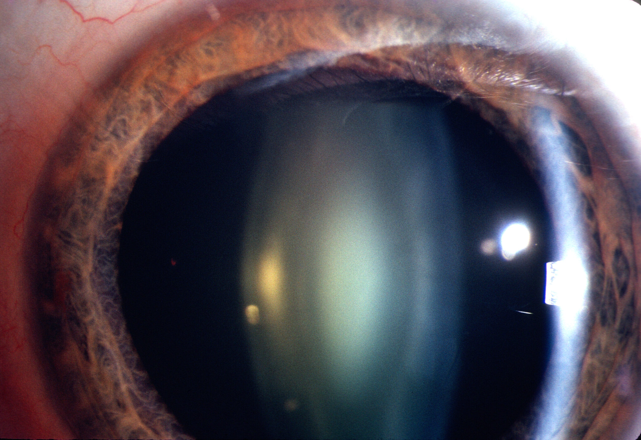 Anesthesia for Cataract Surgery: Options and Safety