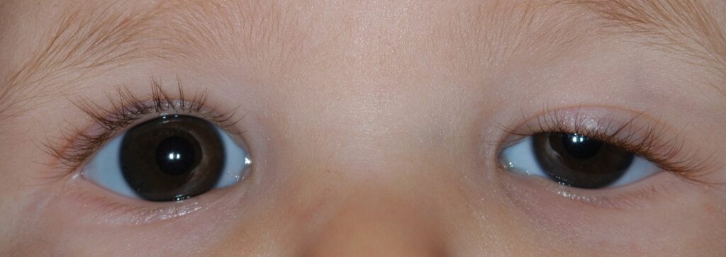 Clinical eye photograph illustrating Anisometropia Causes Treatment