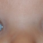 Clinical eye photograph illustrating Anisometropia Causes Treatment