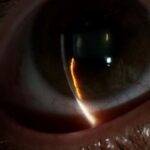 Clinical eye photograph illustrating Anterior Segment Ischemia