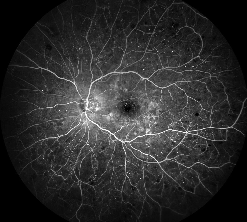 Clinical eye photograph illustrating Anti Vegf Nonproliferative Diabetic Retinopathy