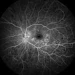 Clinical eye photograph illustrating Anti Vegf Nonproliferative Diabetic Retinopathy