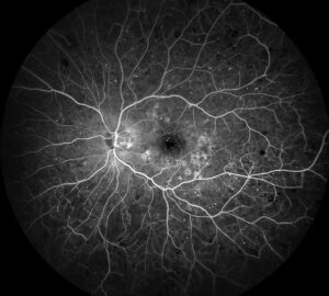 Clinical eye photograph illustrating Anti Vegf Nonproliferative Diabetic Retinopathy