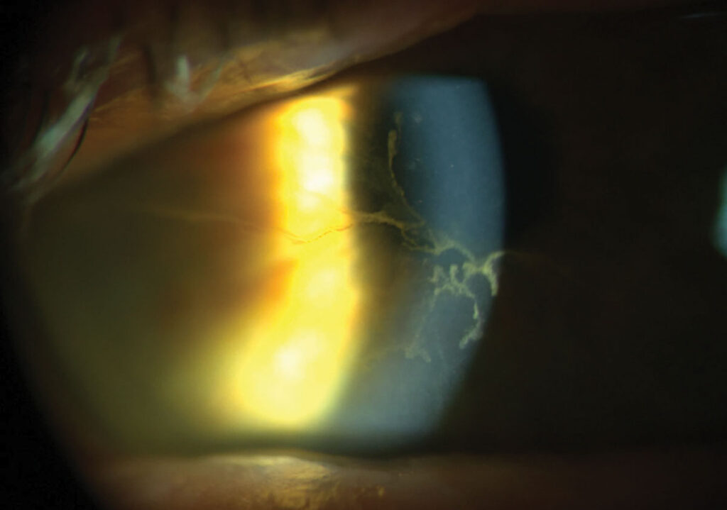 Clinical eye photograph illustrating Aphakia Correction Options