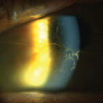 Clinical eye photograph illustrating Aphakia Correction Options